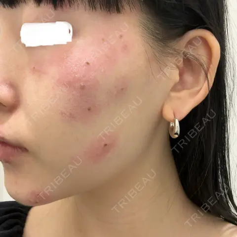 シミ取りレーザー Olino美容外科・美容皮膚科 DAY 0