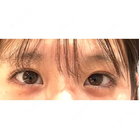 二重埋没 / ヒアルロン酸注入（涙袋） HAAB×DREAM BEAUTY CLINIC 大阪梅田院 AFTER