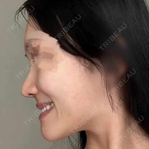 鼻尖形成（切開） / 小鼻縮小（切開） / 軟骨移植 / 鼻尖縮小 / 鼻翼基部形成（貴族手術） 銀座マイアミ美容外科 AFTER