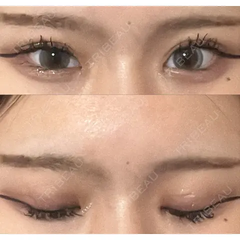 二重埋没 / 目頭切開 HAAB×DREAM BEAUTY CLINIC 大阪梅田院 AFTER