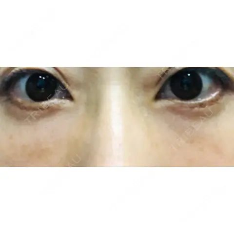 クマ治療 / 下まぶたたるみ取り / 脂肪注入（目の下） 湘南美容クリニック Regno 銀座院 AFTER