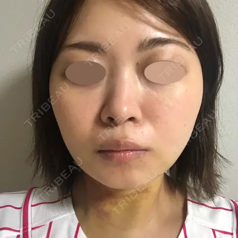 糸リフト / バッカルファット除去 / 脂肪吸引（顔） 湘南美容クリニック 京都院 AFTER
