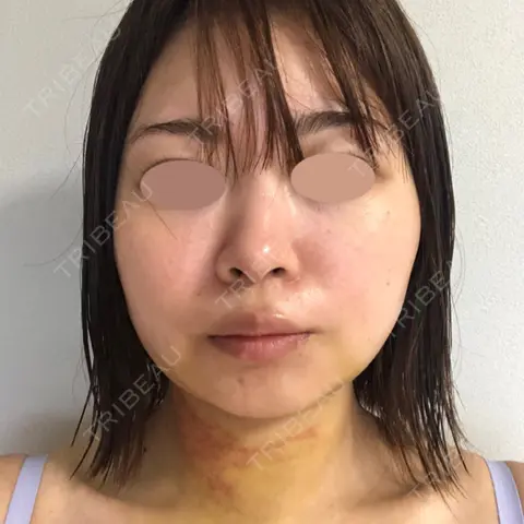 糸リフト / バッカルファット除去 / 脂肪吸引（顔） 湘南美容クリニック 京都院 AFTER
