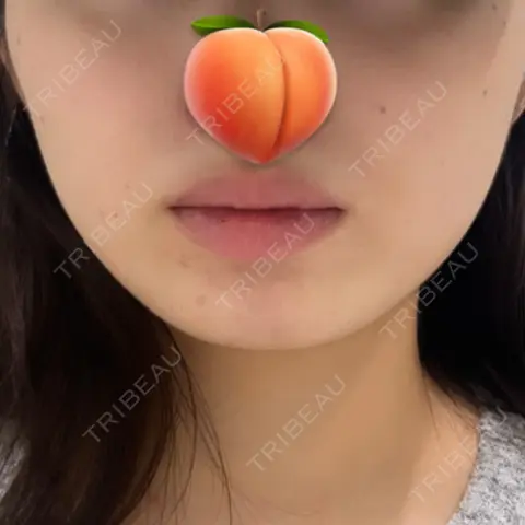 ボトックス（エラ・小顔） DMTC美容皮膚科 渋谷院 AFTER