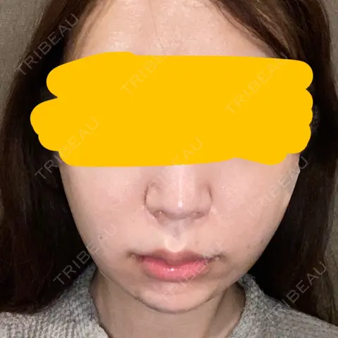 糸リフト / バッカルファット除去 / 脂肪吸引（顔） / メーラーファット除去 / ボトックス（あご） / ヒアルロン酸注入（あご） DIVINE（ディバイン）整形外科 DAY 0