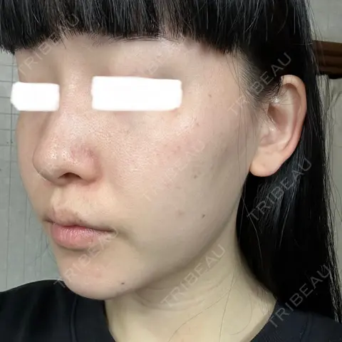シミ取りレーザー Olino美容外科・美容皮膚科 AFTER