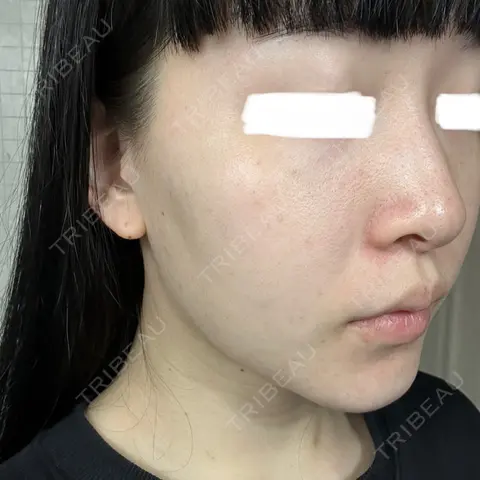 シミ取りレーザー Olino美容外科・美容皮膚科 AFTER