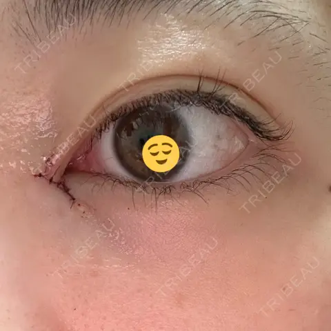 目頭切開 AI Beauty Clinic （エーアイ美容クリニック） DAY 0