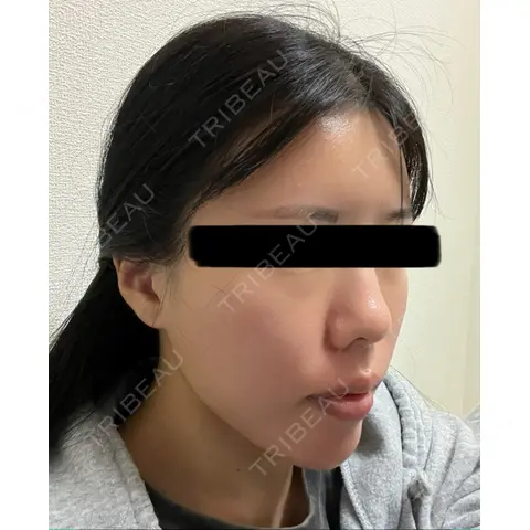 糸リフト / ボトックス（エラ・小顔） EMMO FACE CLINIC 大阪梅田院 AFTER