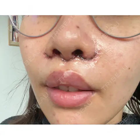 小鼻縮小（切開） / 人中短縮 / 鼻翼挙上 Otus Clinic 【オータスクリニック】 DAY 1