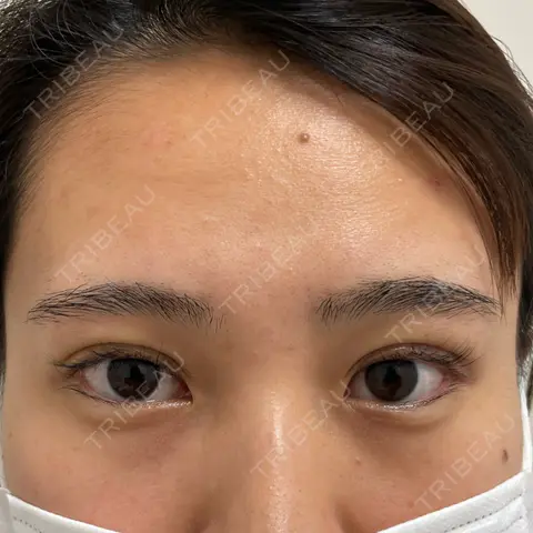 二重埋没 NARU Beauty Clinic 【ナルクリ】 DAY 0