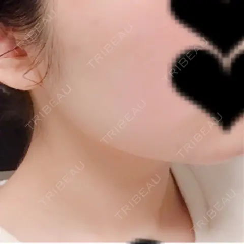 ボトックス（エラ・小顔） 湘南美容クリニック 新宿本院 AFTER