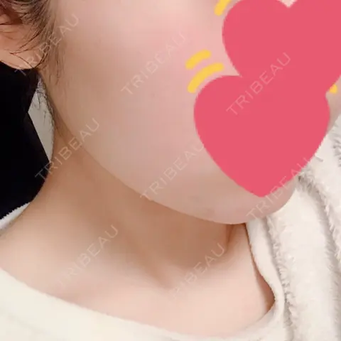 ボトックス（エラ・小顔） 湘南美容クリニック 新宿本院 AFTER