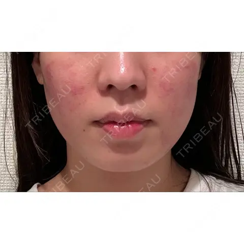 医療痩身（顔） リアルクリニック（REAL CLINIC） DAY 0