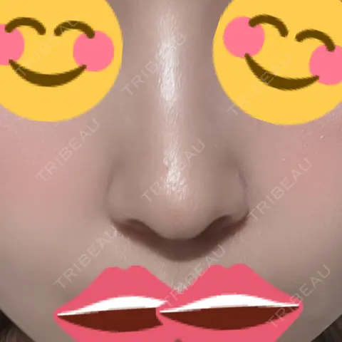 ヒアルロン酸注入（鼻翼基部） DMTC美容皮膚科 日本橋院 AFTER