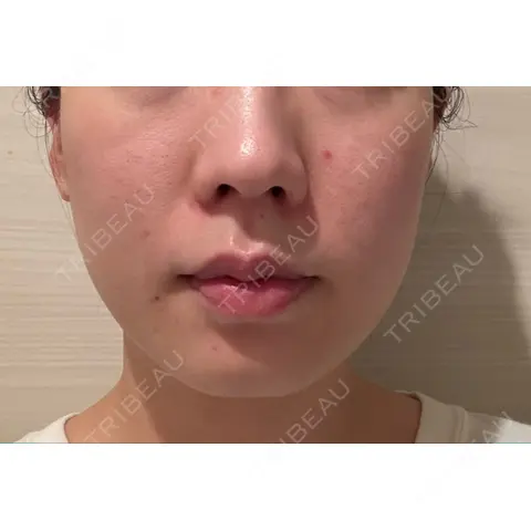 医療痩身（顔） リアルクリニック（REAL CLINIC） AFTER