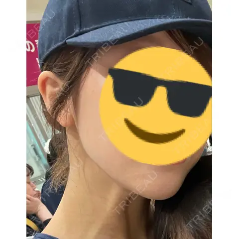 ハイフ（顔） / ハイフ（首） TCB東京中央美容外科 熊本院 AFTER
