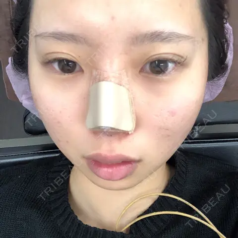 鼻尖形成（切開） 湘南美容クリニック 岡山院 DAY 0