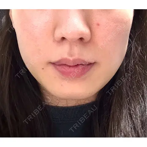 医療痩身（顔） リアルクリニック（REAL CLINIC） AFTER