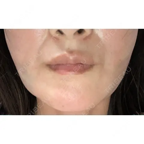 糸リフト / 脂肪吸引（顔） RIVER CLINIC（リバークリニック） DAY 0