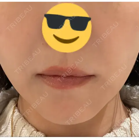 肌ヒアルロン酸注入（たるみ・シワ改善） 湘南美容クリニック 原宿院 DAY 1