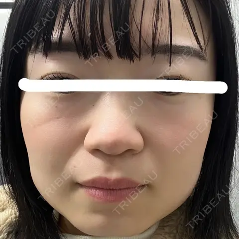 ボトックス（エラ・小顔） 湘南美容クリニック 金山院 DAY 0