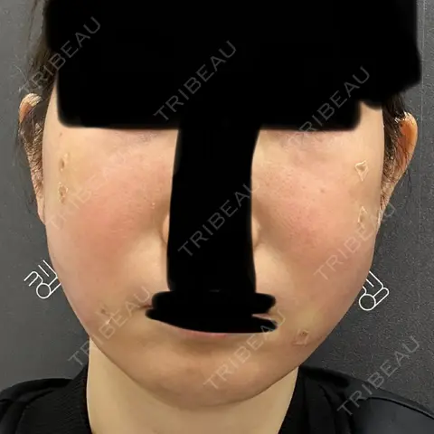 クマ治療 / 脂肪注入（肌） / 脂肪注入（目の下） EMMO FACE CLINIC 大宮院 DAY 0