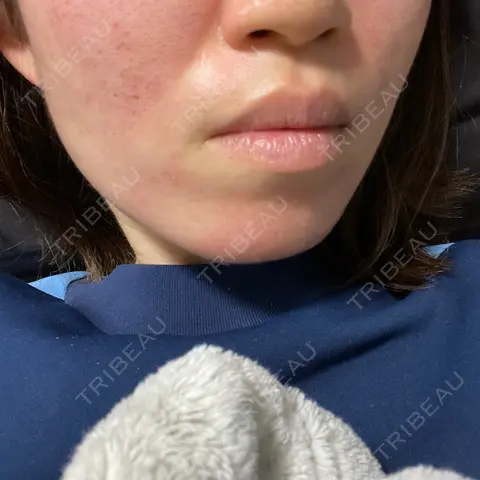 ダーマペン 若倉診療所 DAY 0