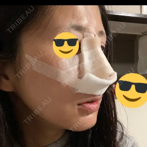 鼻中隔延長（切開） / 小鼻縮小（切開） / 軟骨移植 / 骨切幅寄せ / ワシ鼻修正・ハンプ切除 / その他（鼻） THE ROPPONGI CLINIC（ザ 六本木クリニック） DAY 0