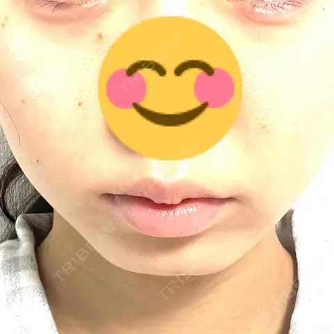 ボトックス（首） veary clinic AFTER