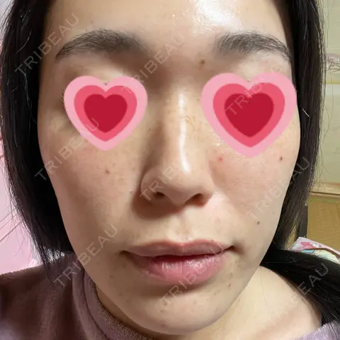 美肌レーザー なのはなクリニック DAY 1