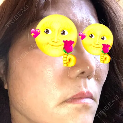 脂肪吸引（顔） 湘南美容クリニック 金山院 DAY 0