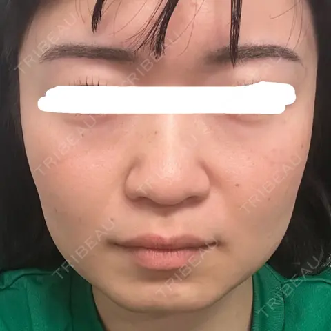 ボトックス（エラ・小顔） 湘南美容クリニック 金山院 AFTER