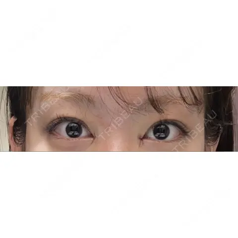 目頭切開 / 美容点滴・美容注射（疲労回復） HAAB×DREAM BEAUTY CLINIC 大阪梅田院 DAY 0