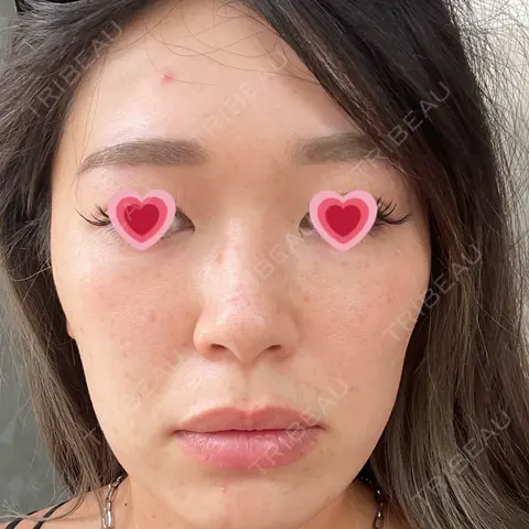 美肌レーザー なのはなクリニック AFTER