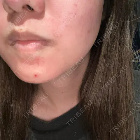 ヴェルヴェットスキン ブリリアスキンクリニック DAY 0