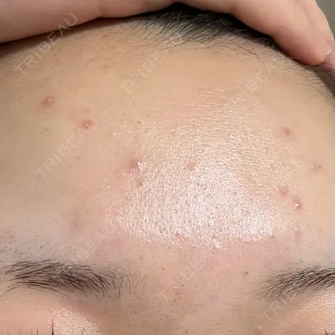 ピーリング（ニキビ・毛穴） LIFIX BEAUTY CLINIC AFTER