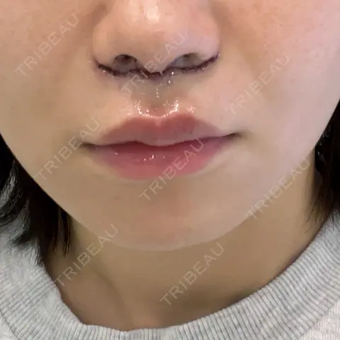 人中短縮 くさのたろうクリニック DAY 0
