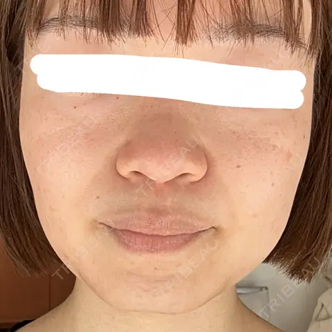 ボトックス（エラ・小顔） 湘南美容クリニック 金山院 AFTER