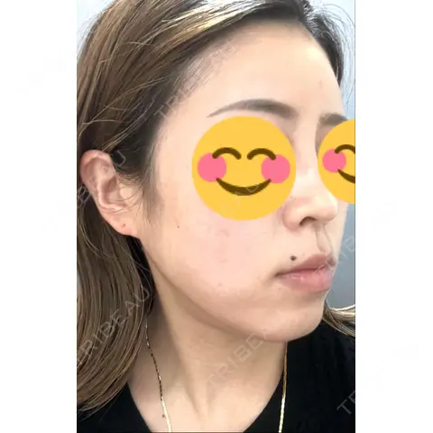水光注射（ハリ・美肌） 東京美容外科 熊本院 AFTER