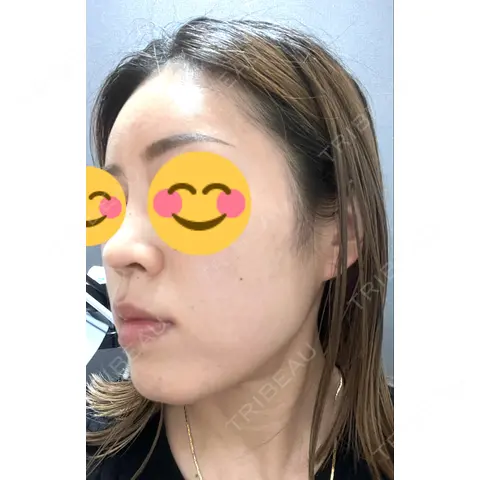 水光注射（ハリ・美肌） 東京美容外科 熊本院 AFTER