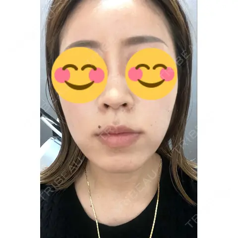 水光注射（ハリ・美肌） 東京美容外科 熊本院 AFTER