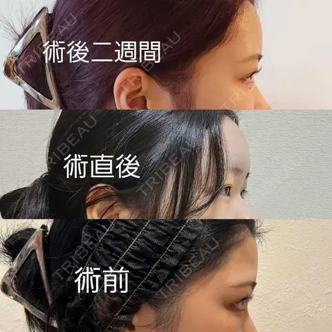 脂肪注入（額） 東京美専クリニック AFTER