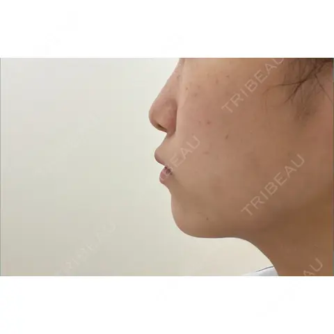 ボトックス（あご） M.CLINIC AFTER