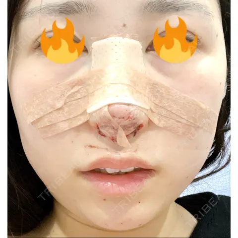 軟骨移植 / 鼻尖形成（非切開） / 鼻柱下降・鼻唇角形成（猫手術） / ヒアルロン酸注入（あご） / その他（鼻） グローバルビューティークリニック 東京院 DAY 0