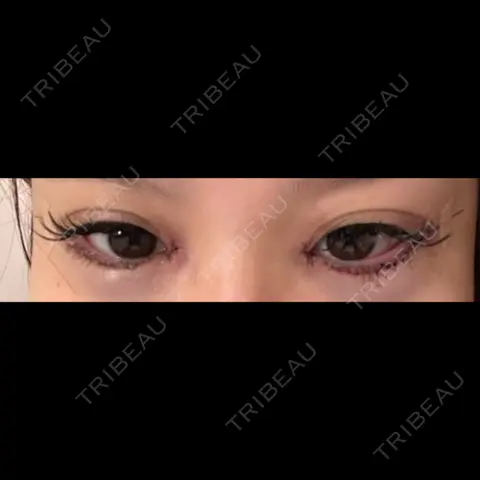 目頭切開 / クマ治療 / 目尻切開 / タレ目形成・グラマラスライン（切開） 銀座TAクリニック DAY 0