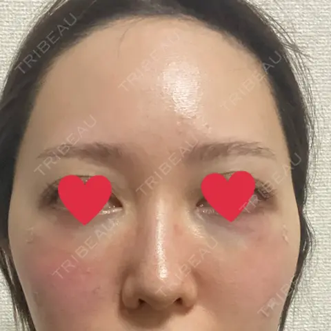 クマ治療 EMMO FACE CLINIC 大宮院 DAY 0