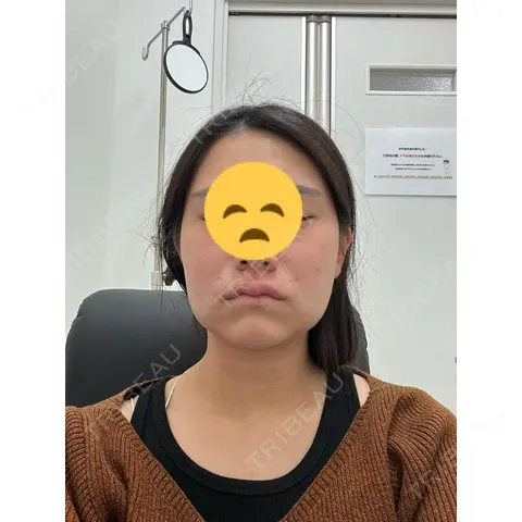 糸リフト / 脂肪吸引注射（顔） / 脂肪注入（輪郭） イテウォンビューティークリニック 名古屋栄院 DAY 0