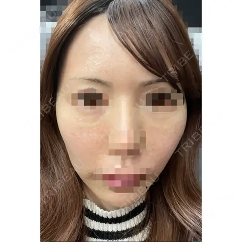 水光注射（ハリ・美肌） LIAN clinic【リアンクリニック】 DAY 0