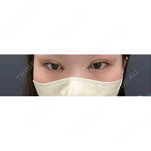 二重埋没 / 目頭切開 AI Beauty Clinic （エーアイ美容クリニック） DAY 0